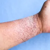 Poignet atteint de dermatite atopique, avec peau rouge, squameuse et irritée.