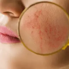 Gros plan sur une peau rougeoyante sous une loupe, signe que ma rosacée a disparu.