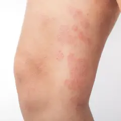 Plaques rouges et squameuses sur la peau des jambes, indiquant une affection cutanée.