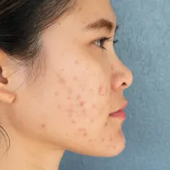 Profil d'une jeune femme avec une peau marquée par des rougeurs et des imperfections, évoquant une **cicatrice zona** ou de l'acné.