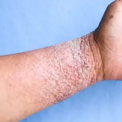 Poignet atteint de dermatite atopique, avec peau rouge, squameuse et irritée.