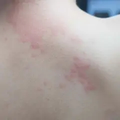 Plaques rouges et surélevées sur le dos, signes de boutons allergie.