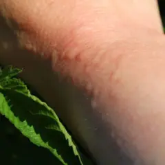 Une peau rougie et boursouflée suite à une piqure d'ortie. Des feuilles vertes d'ortie sont visibles sur le côté.