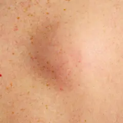 Gros plan sur une peau tachetée de rousseur, avec un bouton dur sous la peau légèrement rouge et gonflé au centre.