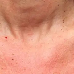 Peau rougie et irritée sur le cou et le décolleté, signe d'une réaction au soleil. Des grains de beauté sont visibles.