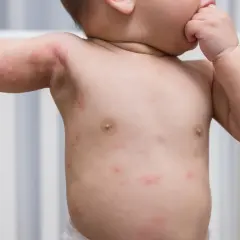 Petit bébé avec un petit bouton rouge sur le visage et le corps, peut-être une éruption cutanée.