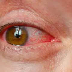 Œil humain avec conjonctive rouge et une petite tache rouge sur la paupière supérieure.