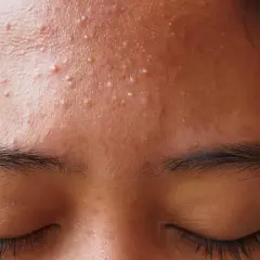 Gros plan sur le front d'une personne, montrant des pores bouchés et de nombreux points blancs. Les yeux sont fermés, les cils longs et sombres.