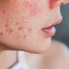 Gros plan sur le visage d'une personne montrant des rougeurs et des papules, symptômes de la rosacée papulo-pustuleuse.