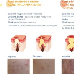 Illustration des différents types d'acné : rétentionnelle (points blancs/noirs), inflammatoire (papules, pustules) et sévère (nodules, kystes).