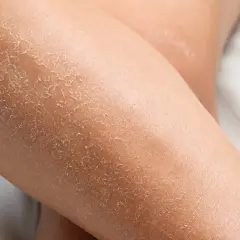 Gros plan sur des jambes sèches, la peau craquelée ressemble à celle d'un lézard.
