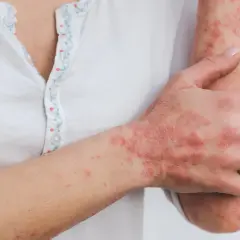 Main d'une personne atteinte de psoriasis, cherchant une cure psoriasis France. Les plaques rouges et squameuses sont visibles sur la main et le bras.