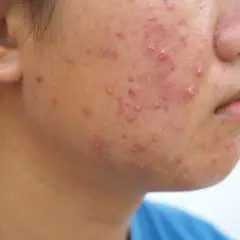 Gros plan sur le visage d'une personne présentant une éruption cutanée rouge et des boutons, possiblement de l'acné fongique.