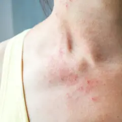 Rougeurs et petites lésions sur le cou et le décolleté, signes d'eczéma sur le corps.