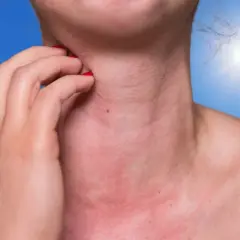 Une personne se gratte le cou, rouge et irrité, sous un soleil éclatant. Une réaction d'allergie soleil visage se manifeste.