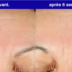 Front du visage avant et après 6 semaines d'utilisation de rétinol. Les rides sont visiblement atténuées.