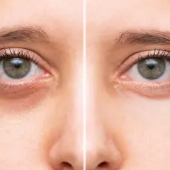 Avant/après : réduction des cernes creuses sous les yeux, améliorant l'apparence de la peau.