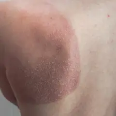 Une petite cloque d'eau sur la peau, signe d'un coup de soleil. La zone affectée est rouge et légèrement gonflée.