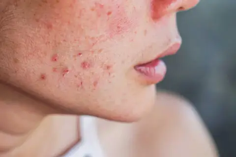 Gros plan sur le visage d'une personne montrant des rougeurs et des papules, symptômes de la rosacée papulo-pustuleuse.