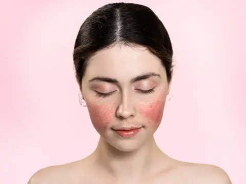 Rougeurs visage - Rosacée, couperose : comment les calmer ?