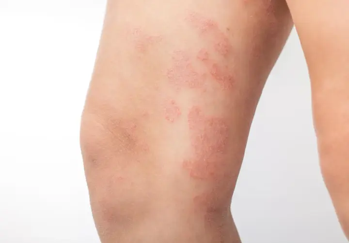 Plaques rouges et squameuses sur la peau des jambes, indiquant une affection cutanée.