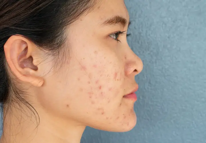 Profil d'une jeune femme avec une peau marquée par des rougeurs et des imperfections, évoquant une **cicatrice zona** ou de l'acné.