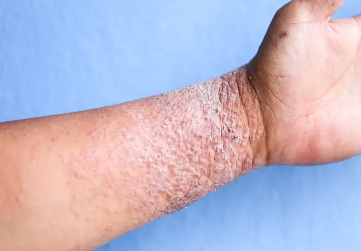 Poignet atteint de dermatite atopique, avec peau rouge, squameuse et irritée.