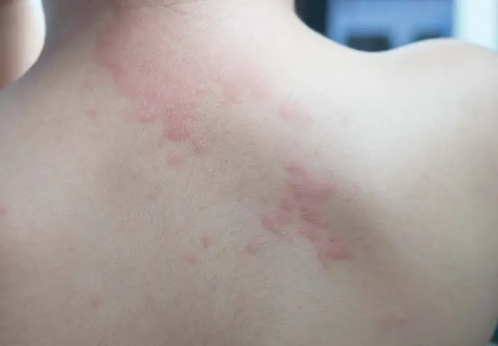 Plaques rouges et surélevées sur le dos, signes de boutons allergie.