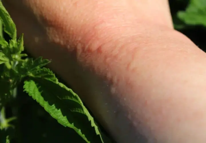 Une peau rougie et boursouflée suite à une piqure d'ortie. Des feuilles vertes d'ortie sont visibles sur le côté.