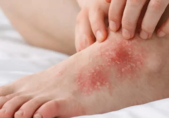 Pied rouge et irrité, avec des plaques blanches et des démangeaisons. Ce **psoriasis eczema pied** cause une gêne importante.