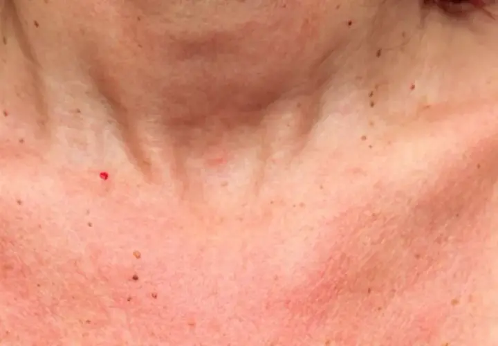 Peau rougie et irritée sur le cou et le décolleté, signe d'une réaction au soleil. Des grains de beauté sont visibles.