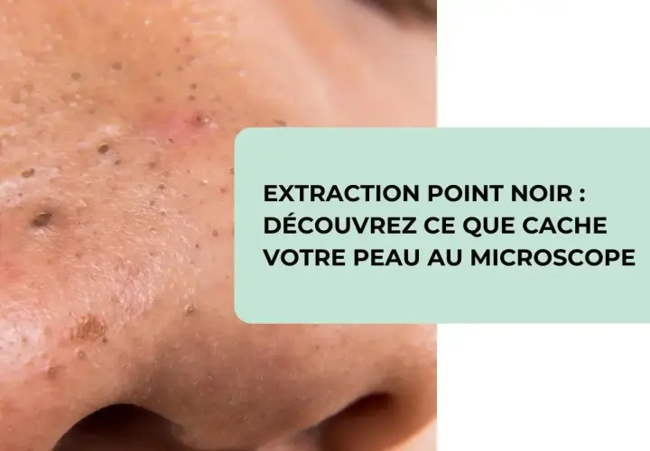 Gros plan sur une peau présentant des points noirs, avec un texte invitant à découvrir ce que cache votre peau au microscope lors de l'extraction de points noirs.