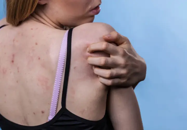 Une personne se gratte le dos, visiblement gênée par une **démangeaison dos** due à des rougeurs et des boutons.