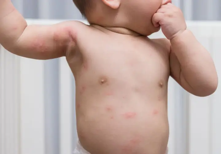 Petit bébé avec un petit bouton rouge sur le visage et le corps, peut-être une éruption cutanée.