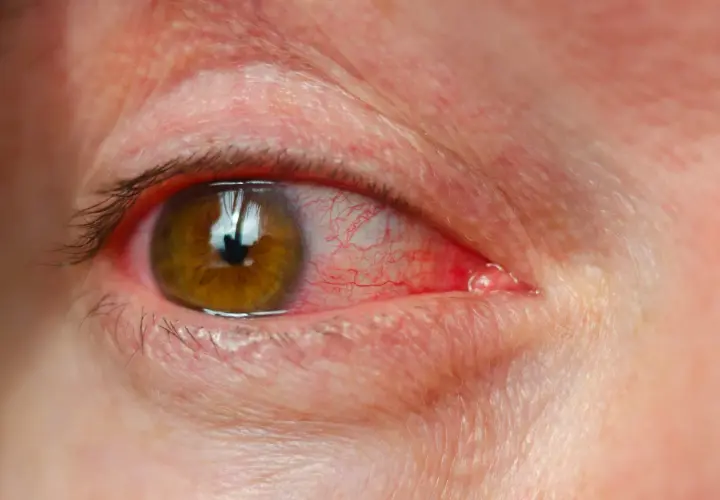 Œil humain avec conjonctive rouge et une petite tache rouge sur la paupière supérieure.