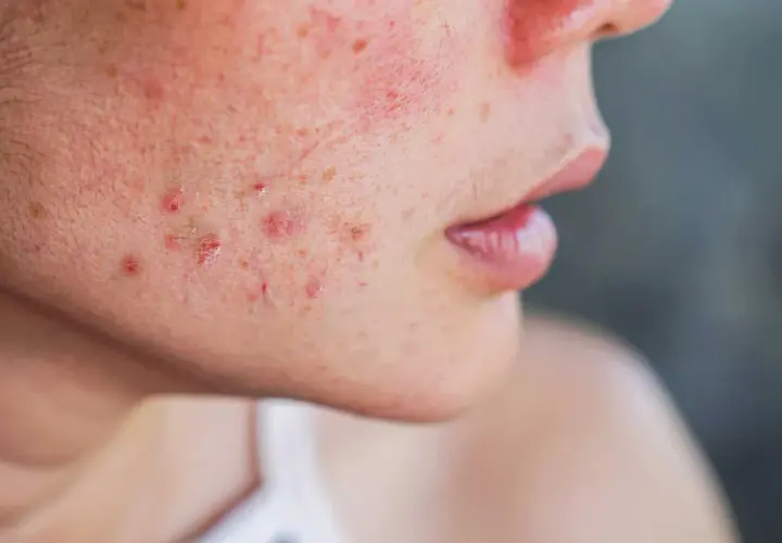 Gros plan sur le visage d'une personne montrant des rougeurs et des papules, symptômes de la rosacée papulo-pustuleuse.