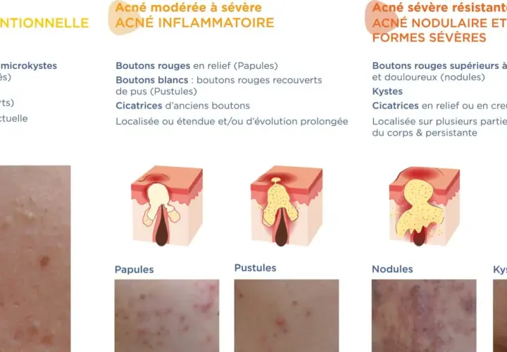 Illustration des différents types d'acné : rétentionnelle (points blancs/noirs), inflammatoire (papules, pustules) et sévère (nodules, kystes).