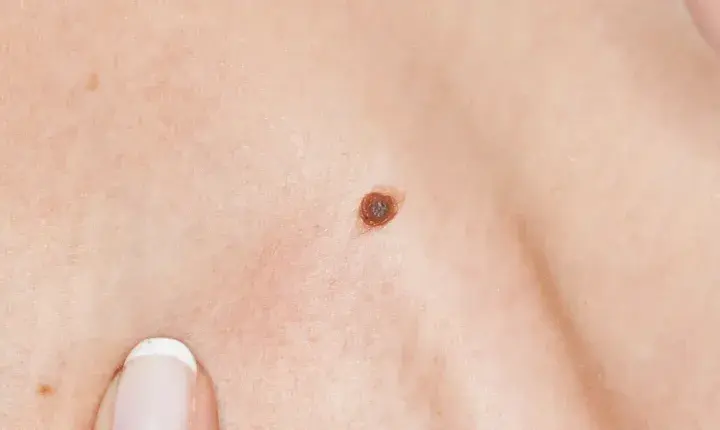 Gros plan sur une peau claire avec un grain de beauté brun foncé. Des doigts manucurés pointent vers la peau.