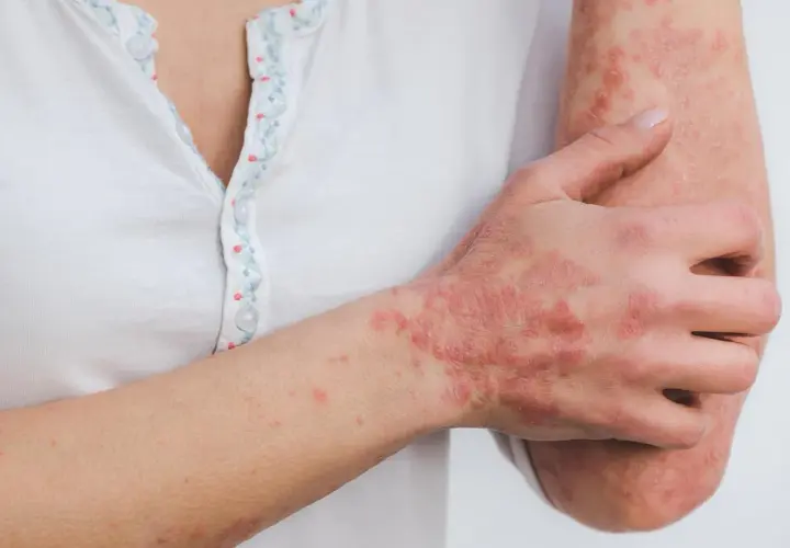 Main d'une personne atteinte de psoriasis, cherchant une cure psoriasis France. Les plaques rouges et squameuses sont visibles sur la main et le bras.