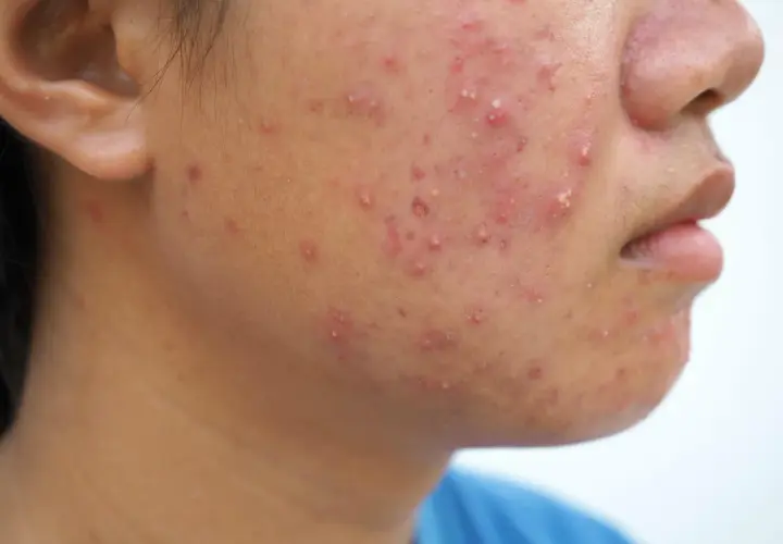 Gros plan sur le visage d'une personne présentant une éruption cutanée rouge et des boutons, possiblement de l'acné fongique.