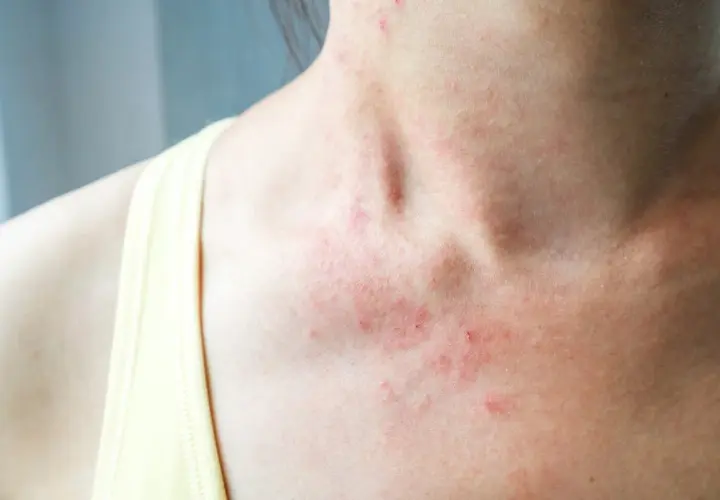 Rougeurs et petites lésions sur le cou et le décolleté, signes d'eczéma sur le corps.