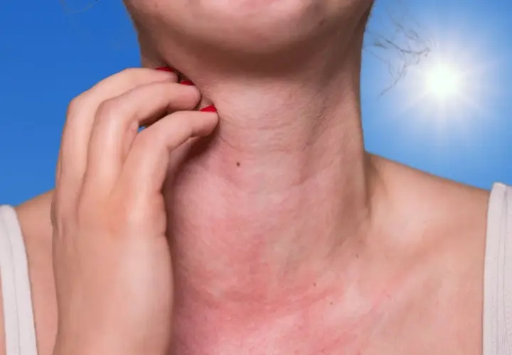 Une personne se gratte le cou, rouge et irrité, sous un soleil éclatant. Une réaction d'allergie soleil visage se manifeste.