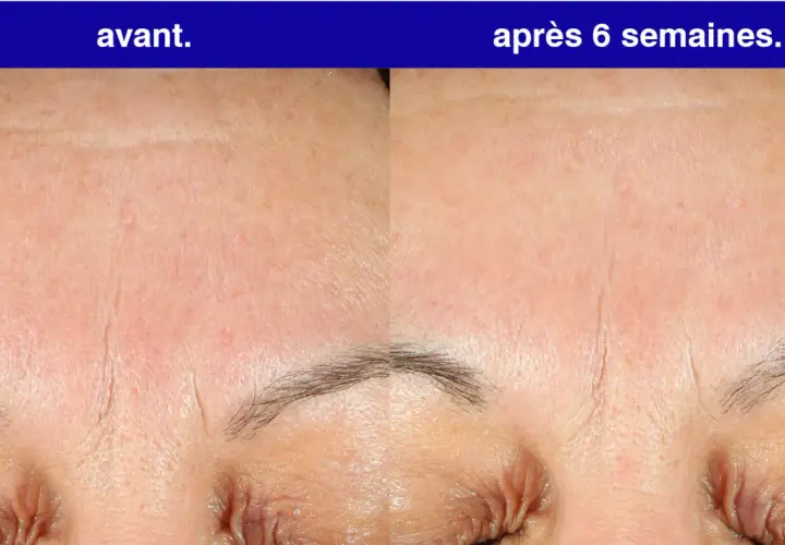 Front du visage avant et après 6 semaines d'utilisation de rétinol. Les rides sont visiblement atténuées.