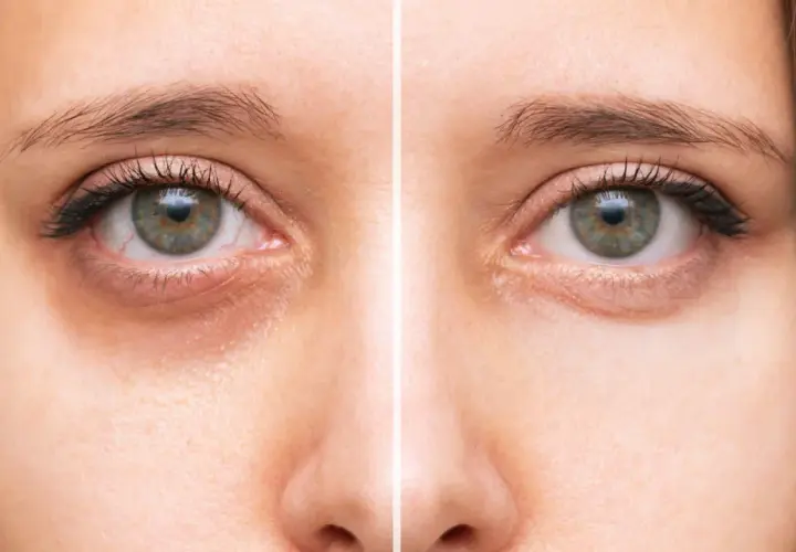 Avant/après : réduction des cernes creuses sous les yeux, améliorant l'apparence de la peau.