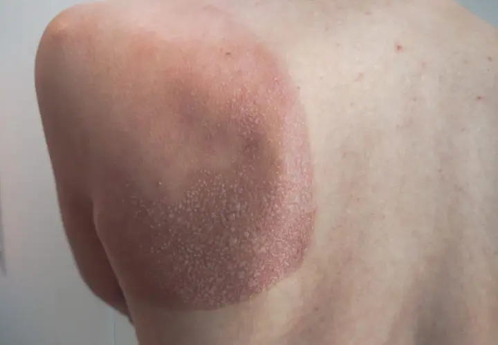 Une petite cloque d'eau sur la peau, signe d'un coup de soleil. La zone affectée est rouge et légèrement gonflée.