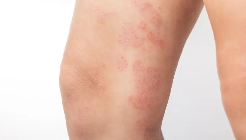 Plaques rouges et squameuses sur la peau des jambes, indiquant une affection cutanée.