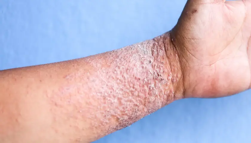 Poignet atteint de dermatite atopique, avec peau rouge, squameuse et irritée.