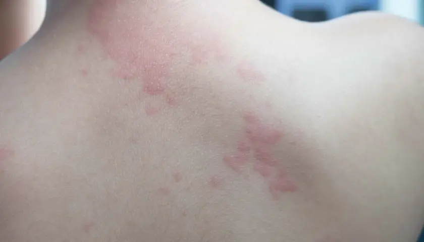 Plaques rouges et surélevées sur le dos, signes de boutons allergie.