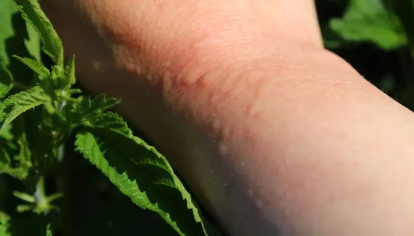 Une peau rougie et boursouflée suite à une piqure d'ortie. Des feuilles vertes d'ortie sont visibles sur le côté.