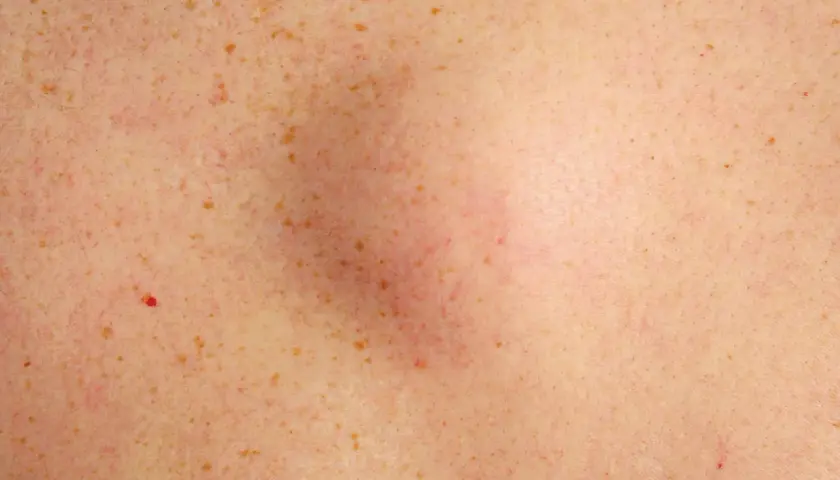 Gros plan sur une peau tachetée de rousseur, avec un bouton dur sous la peau légèrement rouge et gonflé au centre.